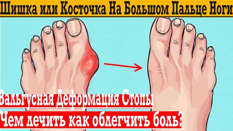 Шишка или косточка на большом пальце на ноги Вальгусная