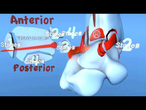 Lauge Hansen PER Pronation External Rotation ( Eversion) Ankle